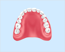 レジン床入れ歯