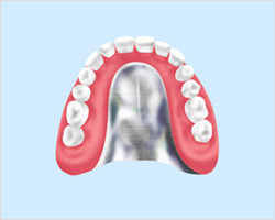 金属床入れ歯
