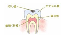 C1（エナメル質の虫歯）