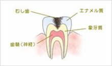 C2（象牙質の虫歯）