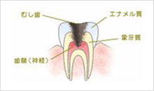 C3（神経の虫歯）