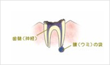 C4（歯根に達した虫歯）